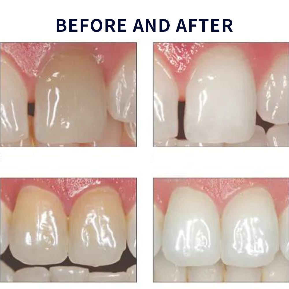 Opalescência Whitening Gel Kit - Teeth Whitening Hydrogen Peroxide avaliação e preço