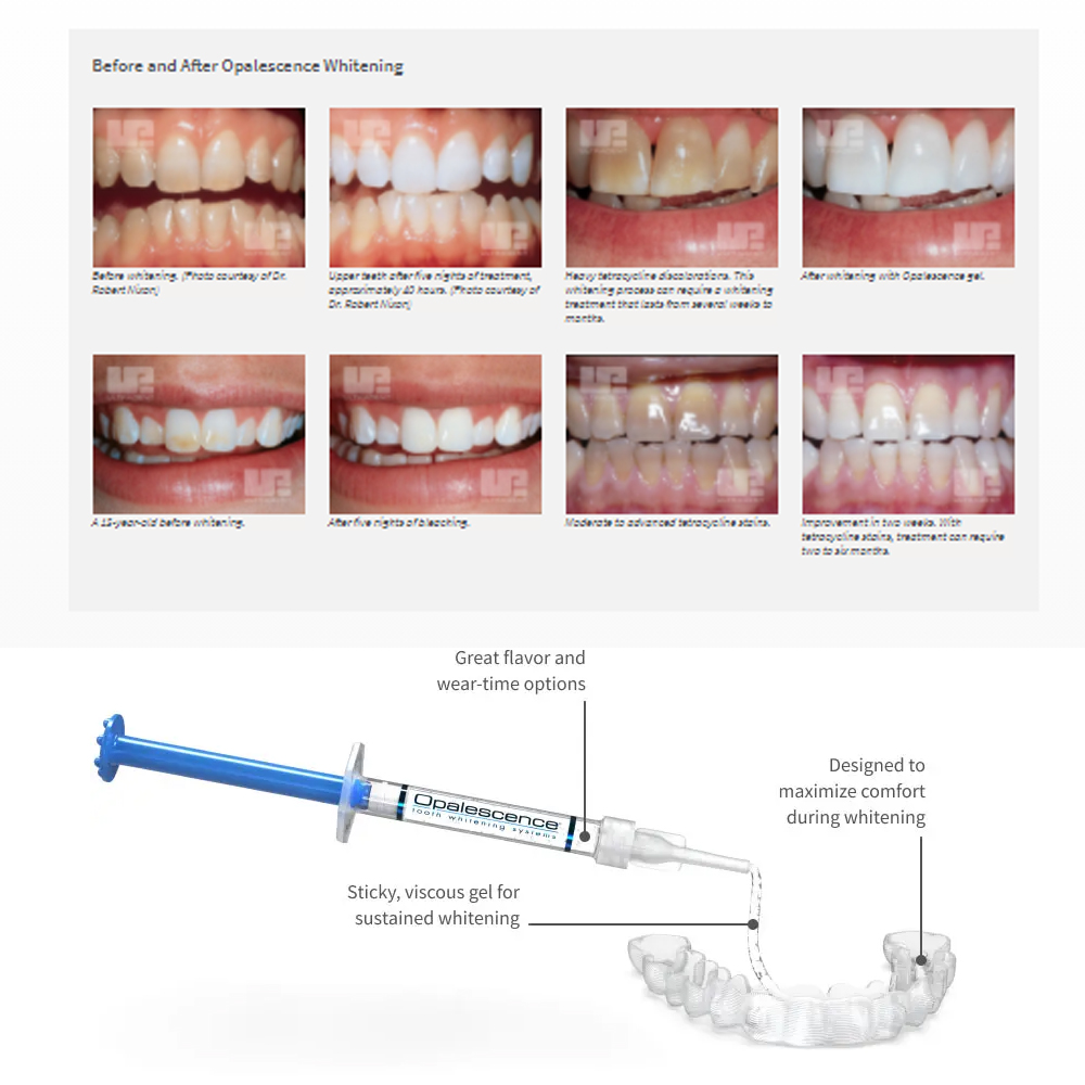 Opalescência Whitening Gel Kit - Teeth Whitening Hydrogen Peroxide avaliação e preço