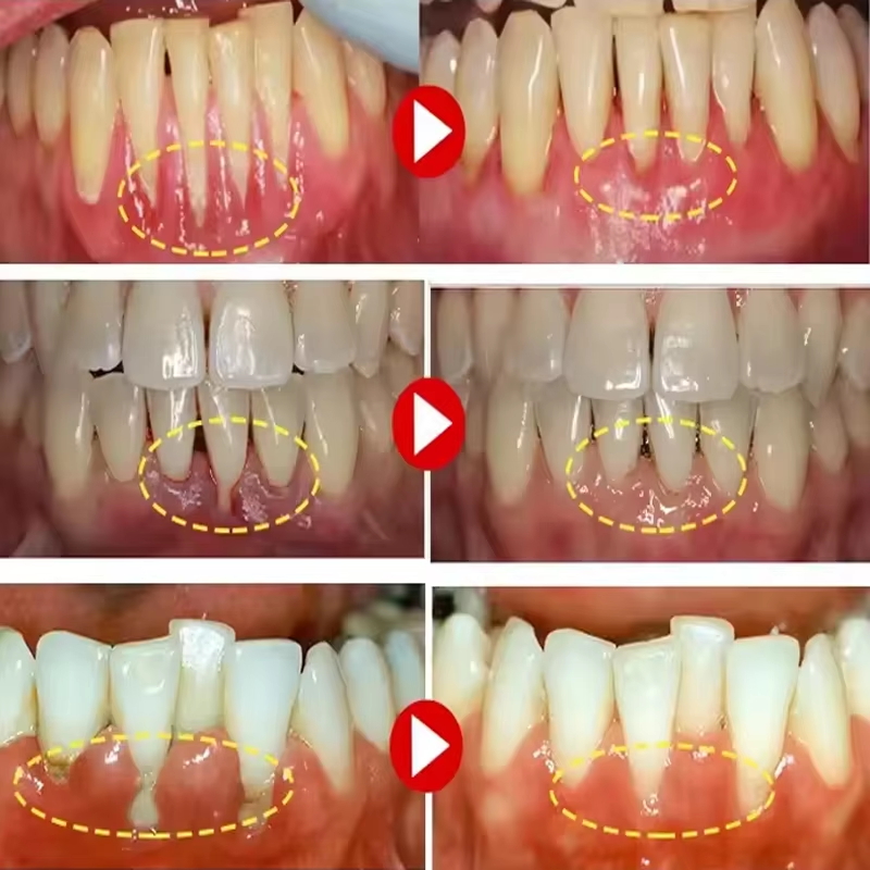 Gel Clareador Dental e Reparad - Teeth Whitening Gels avaliação e preço