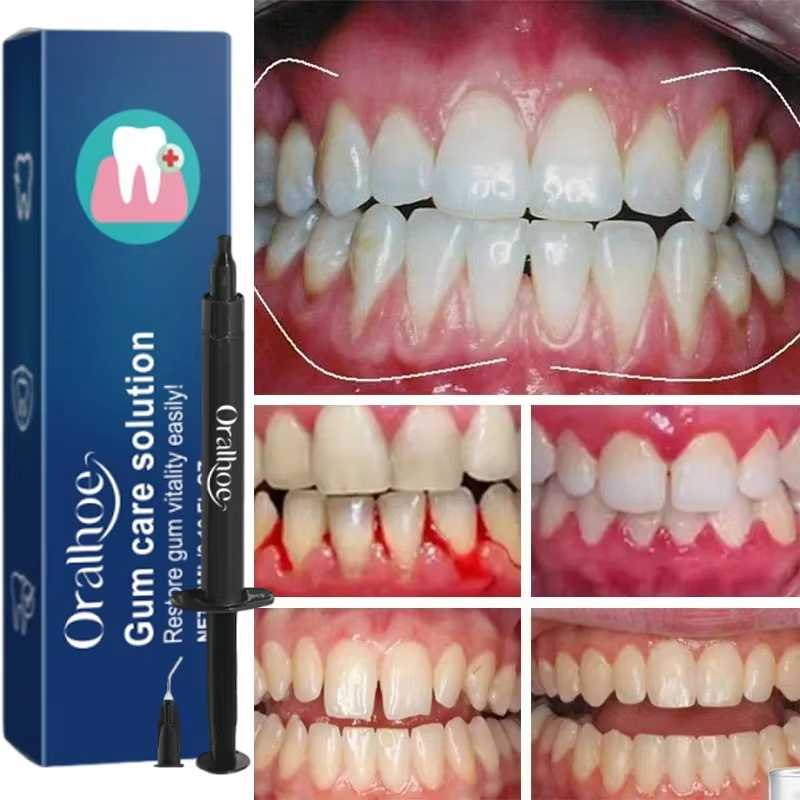 Gel Clareador Dental e Reparad - Teeth Whitening Gels avaliação e preço